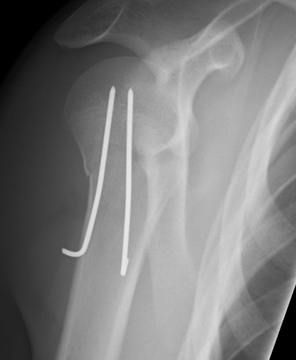 Paediatric Shoulder K wire Lateral
